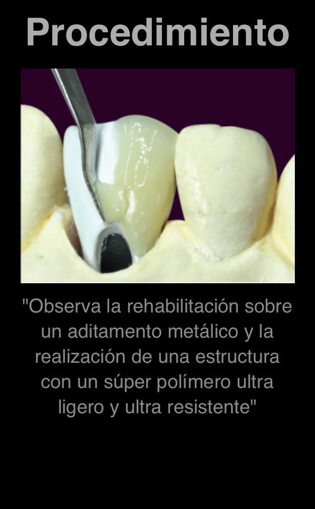 Sistema de prensado Peek - PF Keep más curso GRATIS de 5 días - Implantes y barras de peek. Dental CLEMDE Dental 