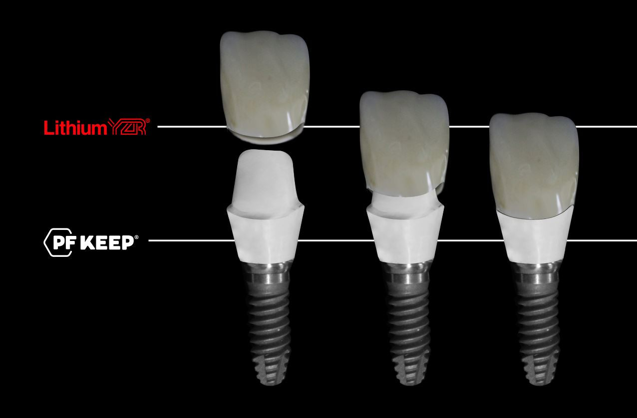 Sistema de prensado Peek - PF Keep más curso GRATIS de 5 días - Implantes y barras de peek. Dental CLEMDE Dental 