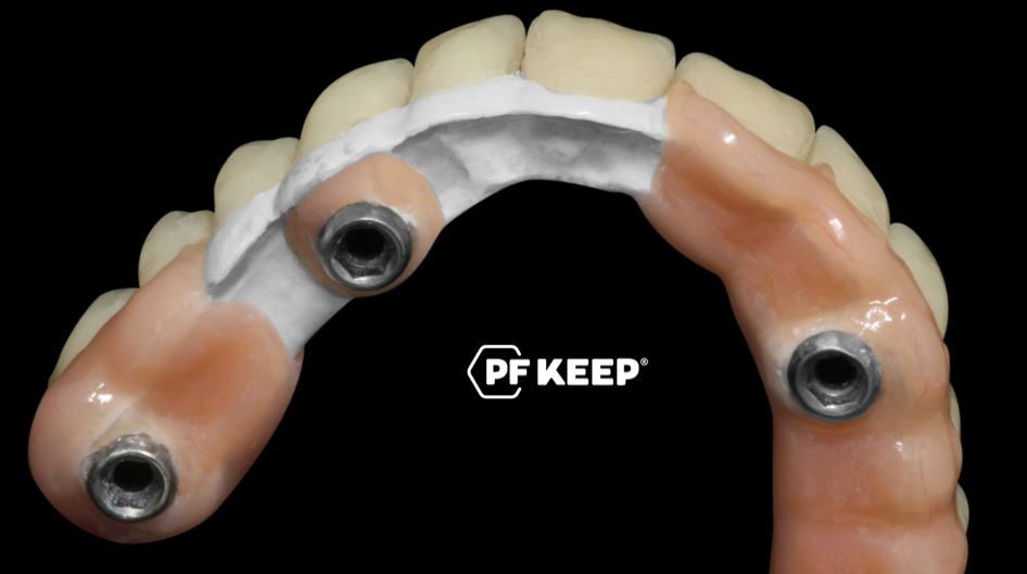 Sistema de prensado Peek - PF Keep más curso GRATIS de 5 días - Implantes y barras de peek. Dental CLEMDE Dental 